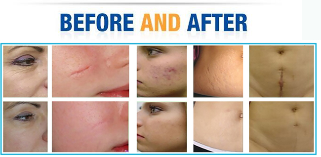 fractional co2 laser treatment before and after