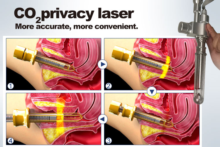 co2 laser for vaginal treatment principle