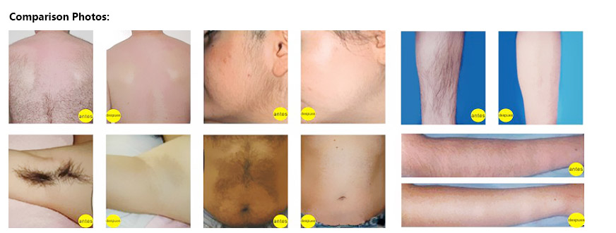 diode laser treatment before and after