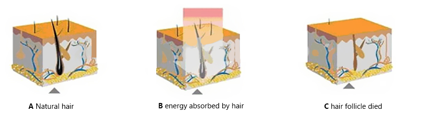 diode laser treatment principle