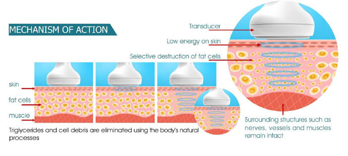 hifu treatment principle