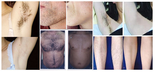 ipl hair removal before and after