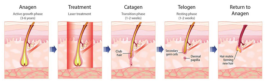 ipl hair removal treatment principle