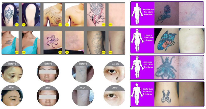 nd yag laser before and after