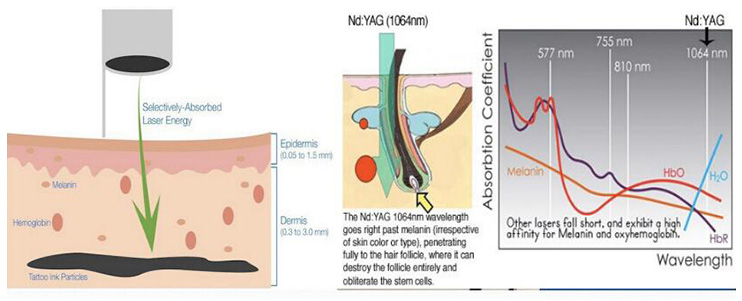 q switched nd yag laser treatment principle