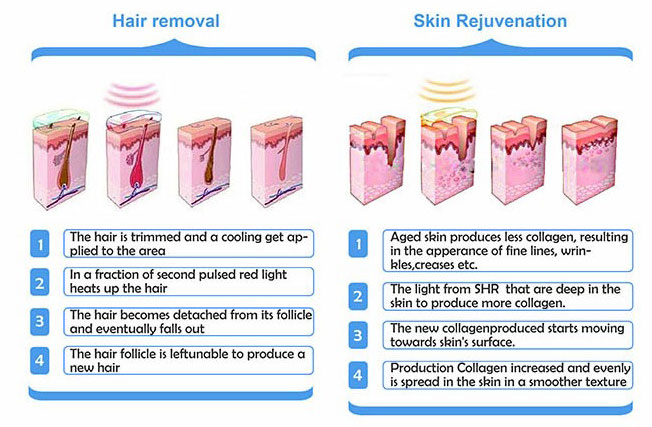 opt ipl treatment principle