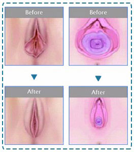 co2 laser Vaginal before and after