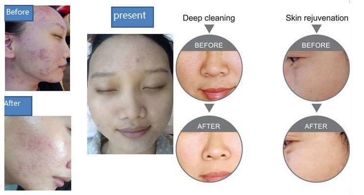 Water & Oxygen Jet Facial Machine Before and After